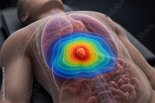 Radiation therapy dose map over chest tumor