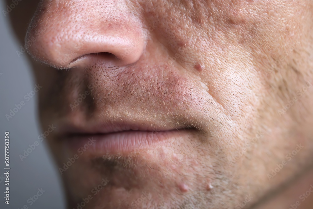 Fototapeta premium Adult Male Acne Close Up with Realistic Facial Skin Texture