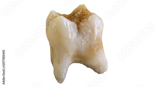 Bild auf Leinwand Human molar tooth with decay and staining