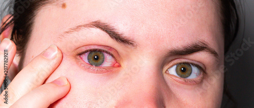 Obraz na plátně Red eye due to viral or bacterial infection