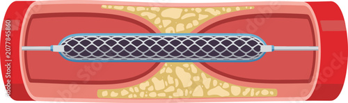 Bild auf Leinwand Angioplasty balloon stent opening blocked artery with cholesterol plaque, medical vector illustration of atherosclerosis treatment