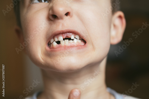 A cheerful child proudly showing a missing upper milk tooth. Concept of childhood growth, dental development, and family moments. Perfect for pediatric dentistry, tooth loss. 