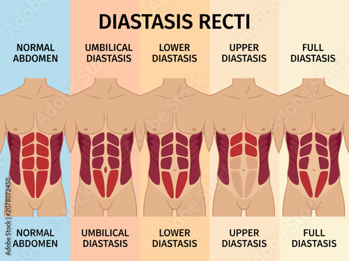 An anatomical illustration of diastasis recti depicts various levels of muscle separation, providing insight into this condition relevant for health and fitness education.