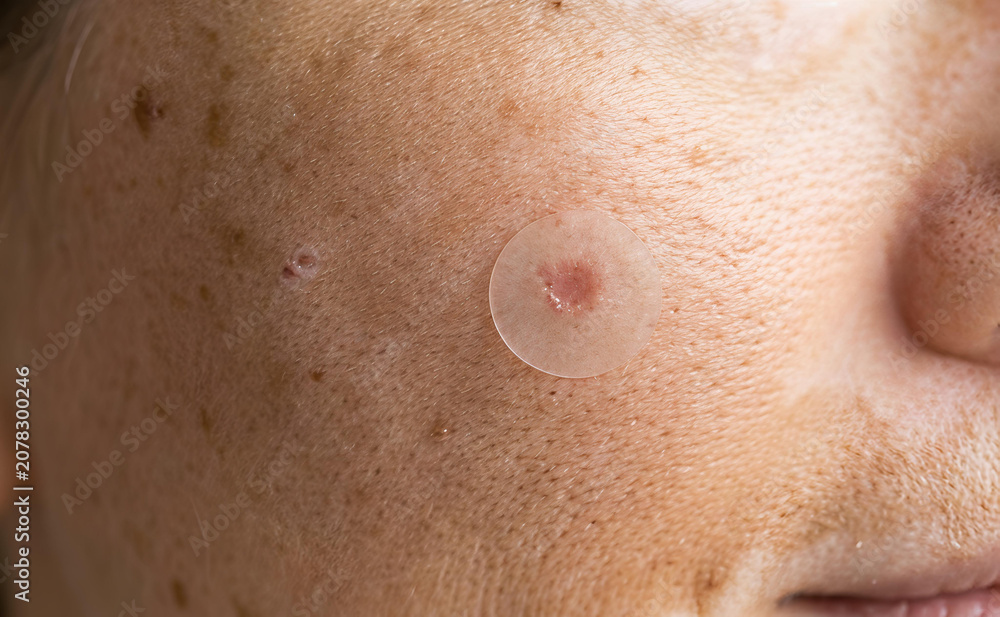Fototapeta premium Hydrocolloid acne patch on inflamed pimple with freckled skin
