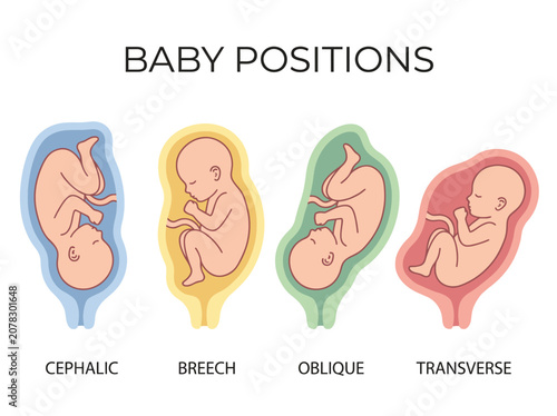 An informative illustration depicting various baby positions during pregnancy stages, including cephalic, breech, oblique, and transverse, highlighting important prenatal knowledge.