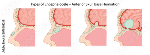 Foto Types of Encephalocele – Anterior Skull Base Herniation, progressive types of anterior encephalocele with herniation of the meninges and brain tissue through defects in the skull base