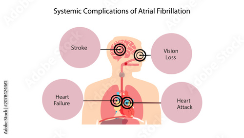 Valokuva Systemic Complications of Atrial Fibrillation, the major systemic complications of atrial fibrillation, including ischemic stroke, vision loss, heart failure, and myocardial infarction