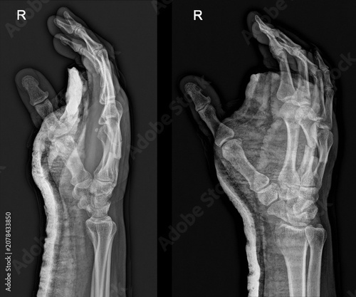 Photos Imaging Analysis of Hand Trauma: Metacarpal Fracture Patterns and Assessment