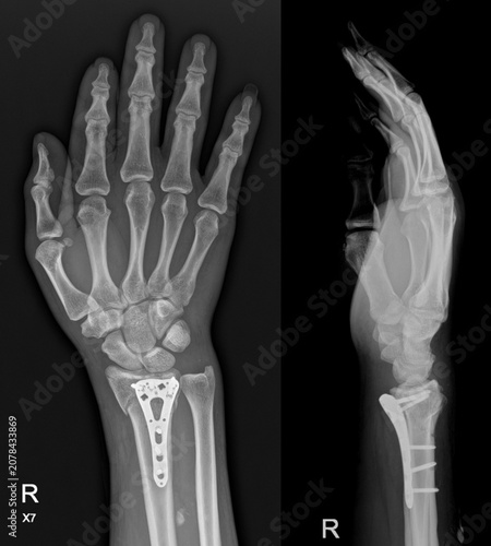 Bild auf Leinwand Imaging Follow-up of Distal Radius Fractures: Assessing ORIF and Hardware Placement