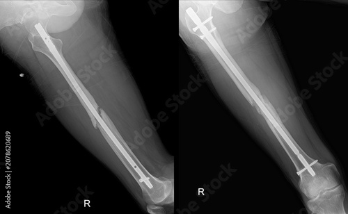 Принти на полотні Postoperative Medical X-ray of Femur Showing Surgical Internal Fixation of Mid-Shaft Fracture