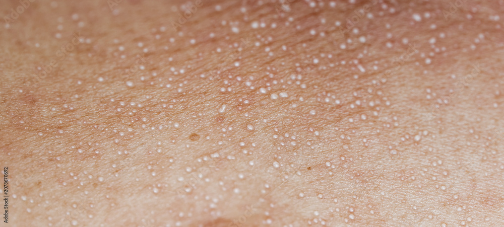 Fototapeta premium Macro close up of sweat droplets on human skin texture, perspiration pores or heat rash condition, medical and wellness concept