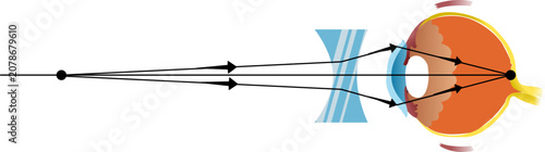 rays focusing behind the retina, causing difficulty with near vision. It is corrected by a convex lens