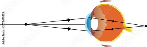 Photos rays focusing behind the retina, causing difficulty with near vision
