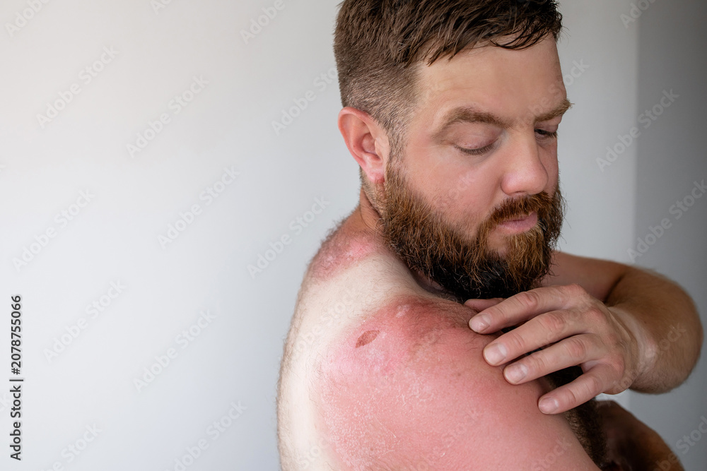 Naklejka premium Side profile of bearded man touching painful sunburnt skin on shoulder, severe sunburn with peeling texture and skin damage after sun exposure