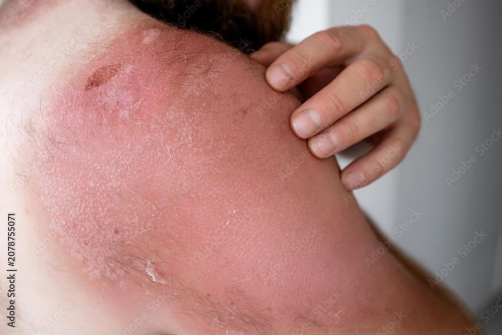 Fototapeta premium Side profile of bearded man touching painful sunburnt skin on shoulder, severe sunburn with peeling texture and skin damage after sun exposure
