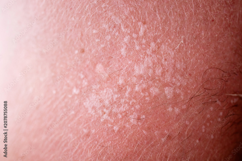 Fototapeta premium Macro close up of skin rash texture with small hypopigmented patches, scaly white spots on red irritated skin, tinea versicolor dermatology concept