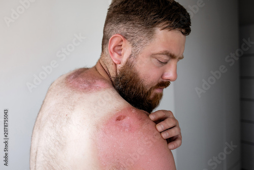фотографія Side profile of bearded man touching painful sunburnt skin on shoulder, severe s