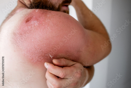 Photos Side profile of bearded man touching painful sunburnt skin on shoulder, severe s