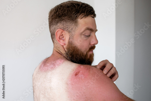 Photos Side profile of bearded man touching painful sunburnt skin on shoulder, severe s