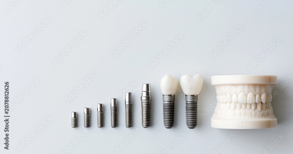Fototapeta premium Dental implants and teeth model progression