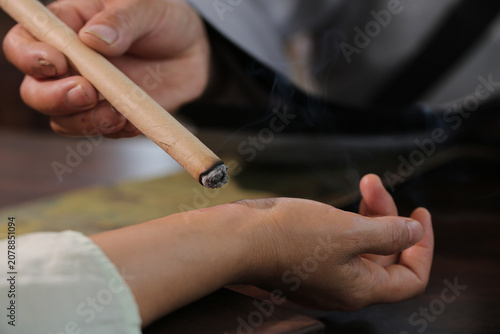 Bild auf Leinwand Moxibustion Traditional Chinese Medicine Therapy with Burning Moxa Stick for Hea