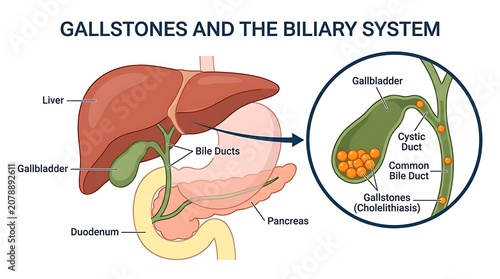 Medical illustration of gallstones and anatomy of the human biliary system