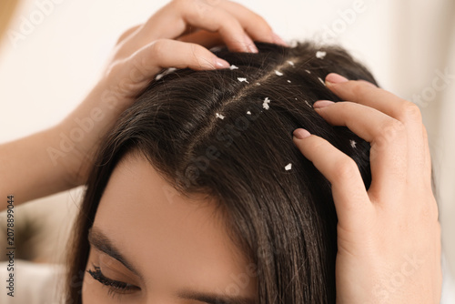 Young woman with dandruff p...