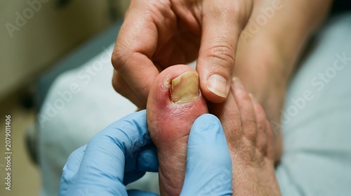 Close up of medical professional examining ingrown toenail on foot