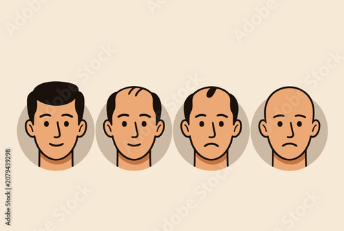Informative medical illustration showing the four stages of male pattern baldness, from full hair to complete hair loss.