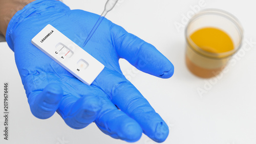 Canvastavla Urinary antigen test (UAT) is the primary and fastest method for diagnosing legionellosis