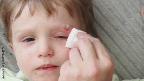 Close-up of the boy's face with a sadina. The child treats the wound on the face. A mother treats a child's scratch with antiseptic and anesthetic cream.