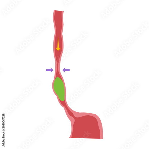 Obraz na plátně Diagram illustrates a narrowed passage in a biological tube with a blockage