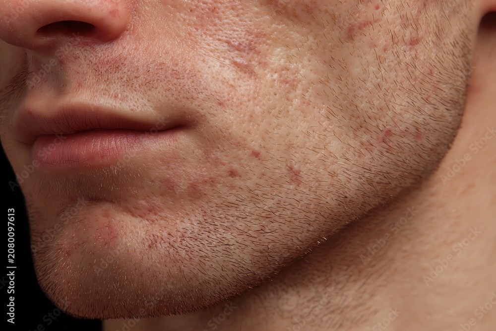 Fototapeta premium Male Hormonal Acne Concept Around Jaw and Chin Area