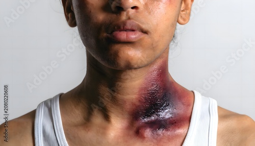 Clavicle area bruising after impact injury in detailed medical photo view.