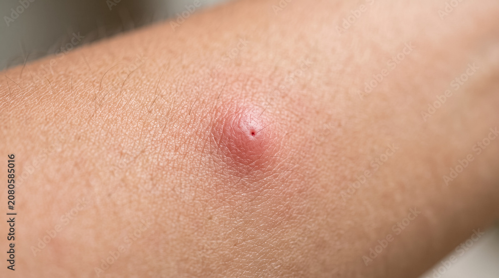 Fototapeta premium Human arm skin showing red inflamed insect bite bump signaling allergy, irritation, or infection