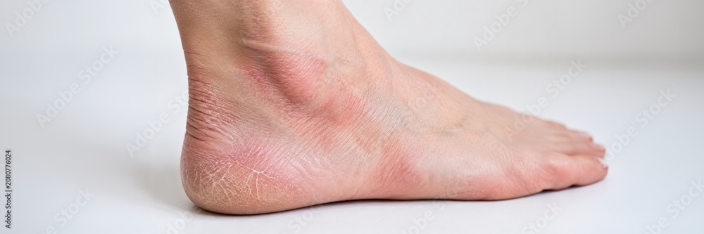 Fototapeta premium Dry red heel skin, website banner with copy space, eczema