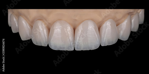 Dental smile design and Hollywood smile. Aesthetic treatment of crooked and deformed teeth using porcelain veneers, aesthetic fillings, and zirconium crowns.