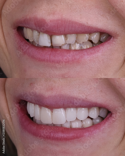 Dental smile design and Hollywood smile. Aesthetic treatment of crooked and deformed teeth using porcelain veneers, aesthetic fillings, and zirconium crowns.