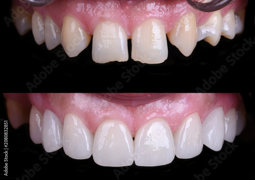 Dental smile design and Hollywood smile. Aesthetic treatment of crooked and deformed teeth using porcelain veneers, aesthetic fillings, and zirconium crowns.