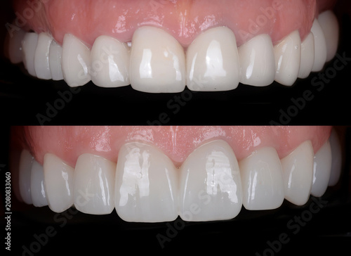 Dental smile design and Hollywood smile. Aesthetic treatment of crooked and deformed teeth using porcelain veneers, aesthetic fillings, and zirconium crowns.