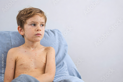 Child With Chickenpox Rash Sitting In Bed