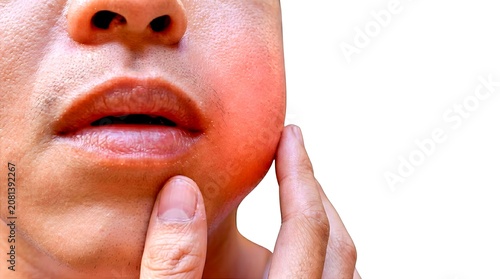 Close-up of a man touching his severely swollen and red cheek due to intense toothache, illustrating dental abscess, gum infection, tooth inflammation, and oral health problems.