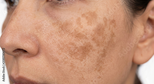 Foto Melasma Macule (Facial Hyperpigmentation) - Macule in Human Skin — Medical Derma