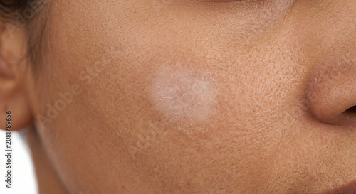 Obraz na płótnie Pityriasis Alba Macule - - Macule in Human Skin — Medical Dermatology Plate (10-