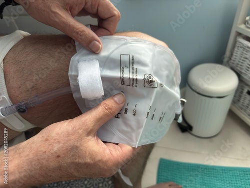 A pair of male hands can be seen attaching a urinary catheter bag his leg. Urology . Medical . Health