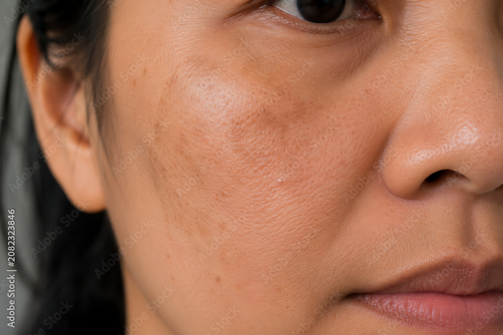 Naklejka premium Melasma on Asian Woman Cheek Close Up with Realistic Skin Texture