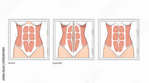 Abdominal muscle anatomy, diastasis recti