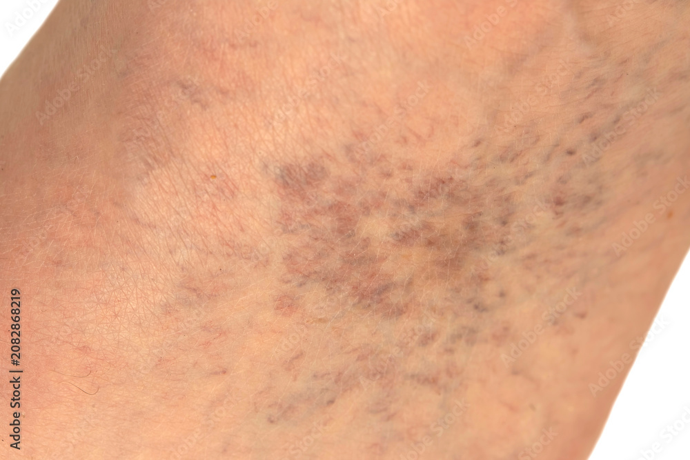 Fototapeta premium Spider veins and blood vessel issues in an adult male foot caused by chronic venous insufficiency, resulting in poor circulation.