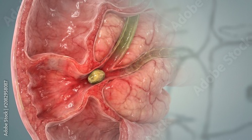 Transparent 3D Model Showing Choledocholithiasis at the Ampulla