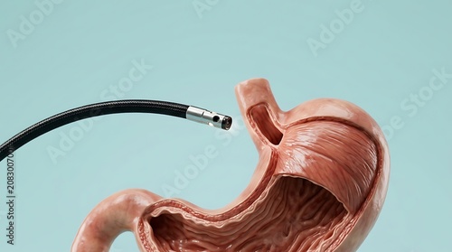 Endoscopy Medical Procedure Illustration of Human Stomach